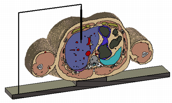 図 1：シミュレーションのセットアップ：HUGO人体モデルの腹部にカテーテルを挿入